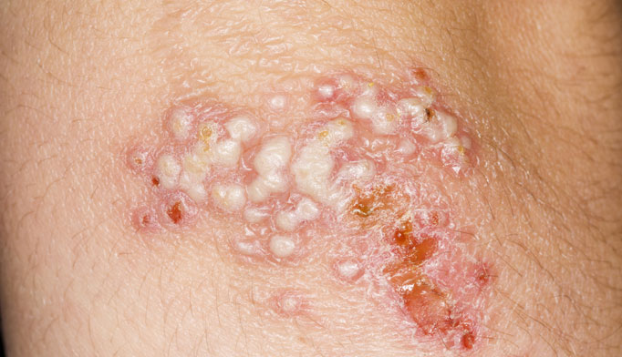 Hsv genital 2 pictures herpes Differences Between